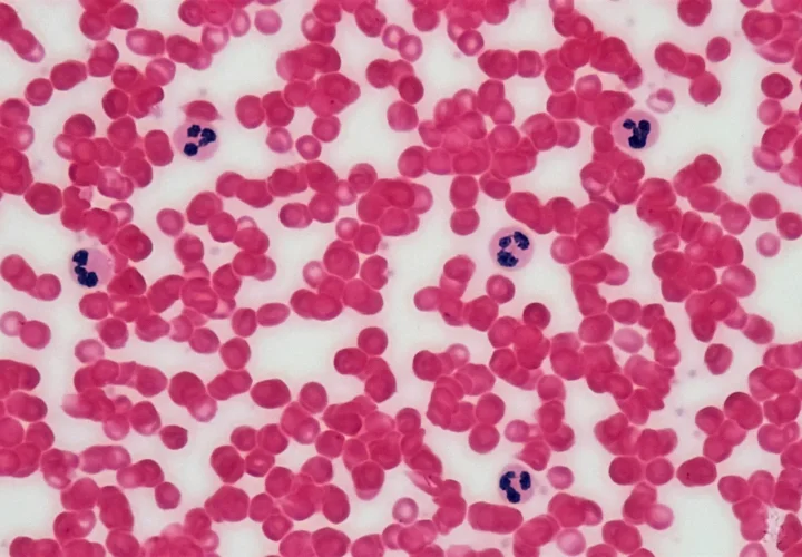 Blood smear showing red blood cells and neutrophils for a hair loss workup