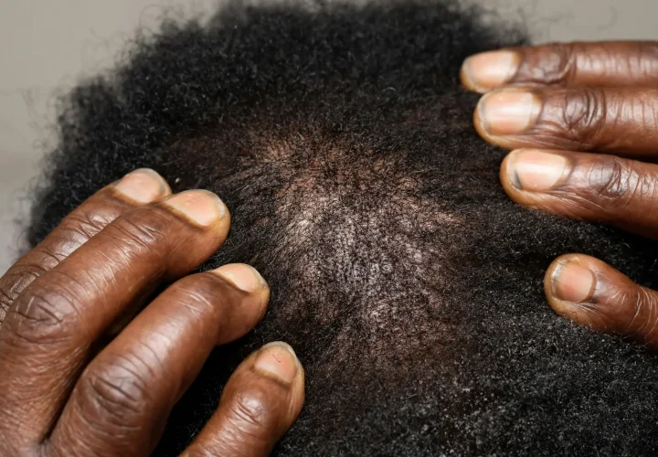 Causes of hair loss in women: close-up of a woman’s scalp with visible hair thinning and exposed scalp