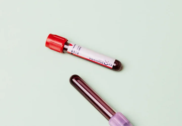 Routine blood tests often miss key biomarkers, leaving many to experience persistent hair loss despite normal bloodwork.